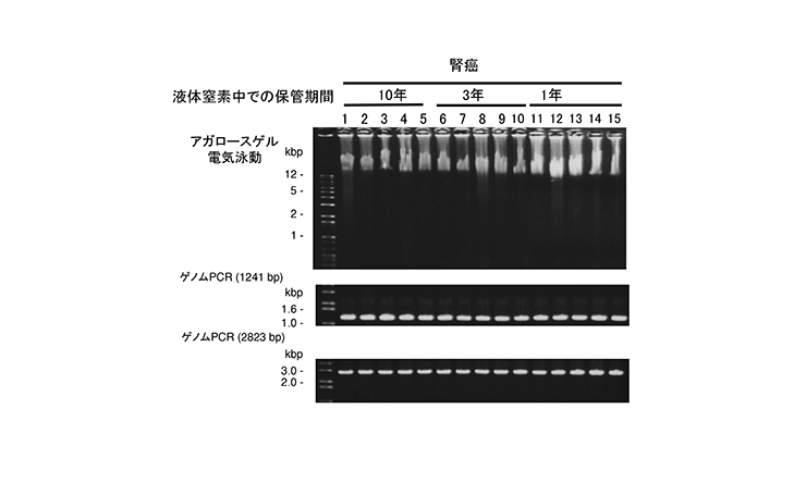 腎癌